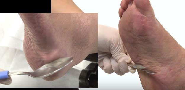 How to Rid Feet of Calluses in 8 Easy Steps