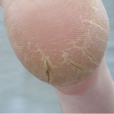 Identify & Address Four Major Foot Problems