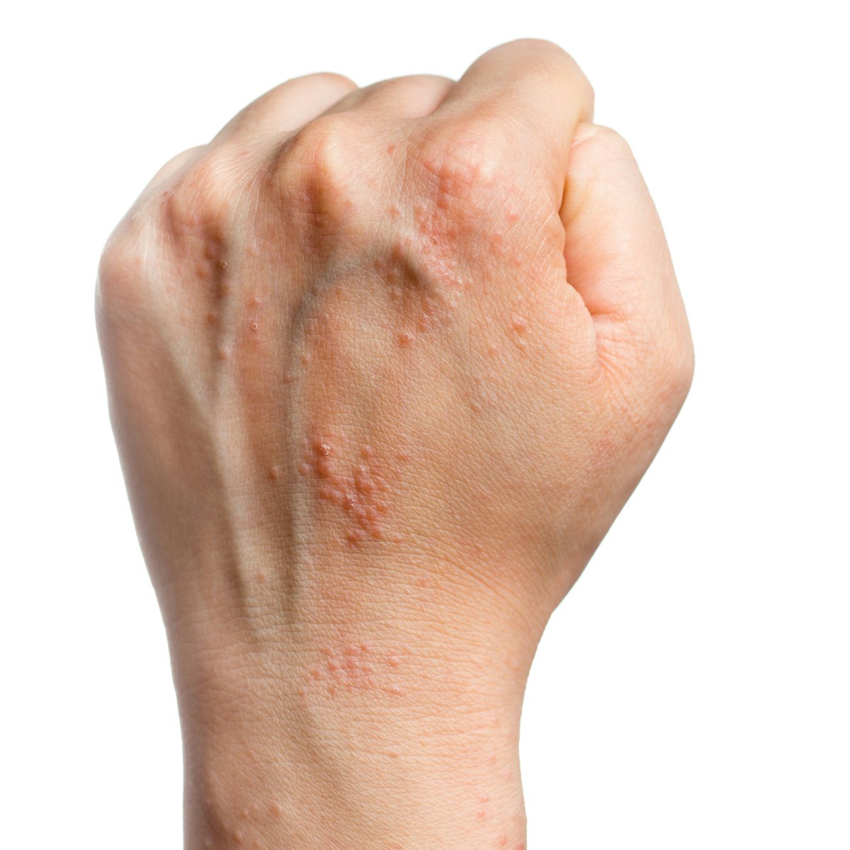 Nail Clinic: Allergy or Irritation Explained
