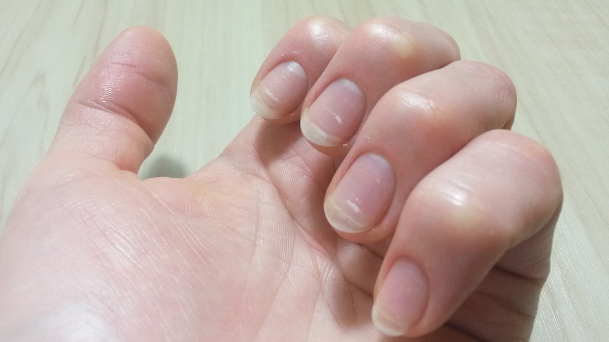 Understanding White Spots on Nails: Causes & Solutions